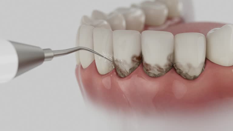 Trusted Dental Implants service in Belle Glade, FL - Dentist Open Now